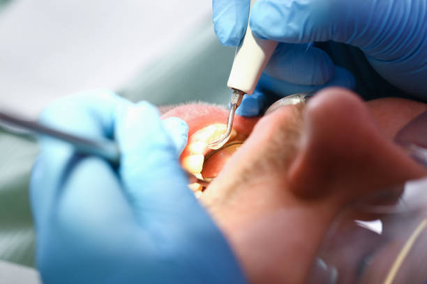Best Emergency Wisdom Teeth Removal in Liolnton, NC