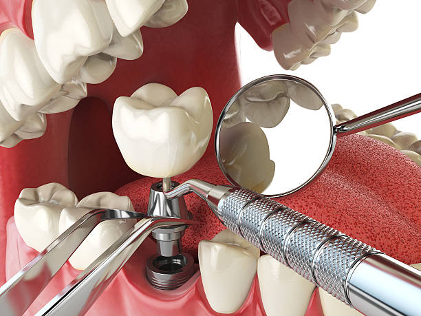 Best Emergency Wisdom Teeth Removal in Liolnton, NC